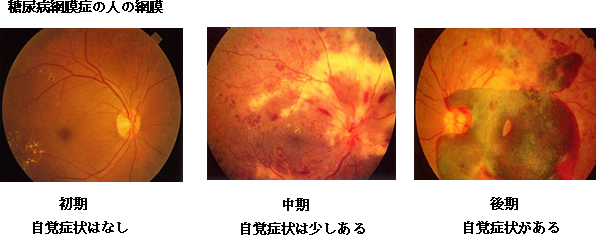 糖尿病網膜症の人の網膜